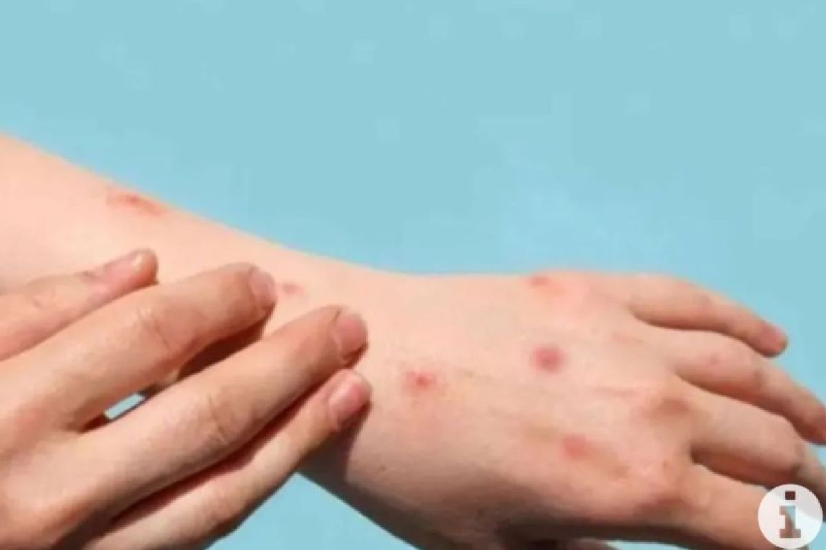 Karakteristik ruam klinis yang sering dijumpai pada penderita Mpox